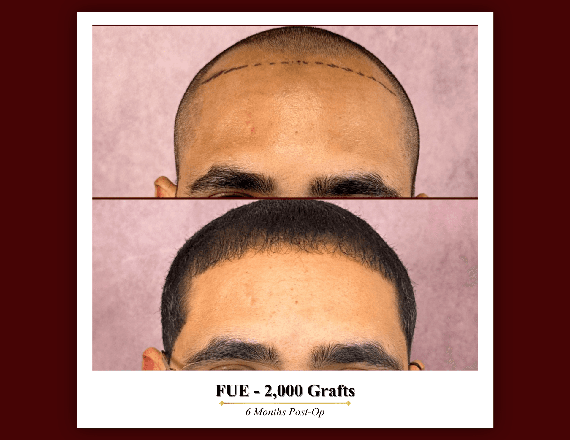 Hair restoration for all hair types