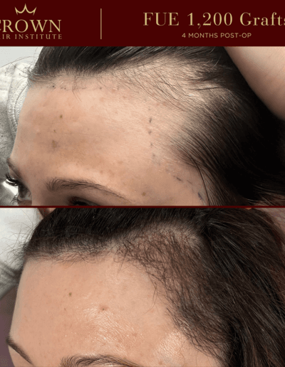 FUE Hair Transplant - Before and After Results