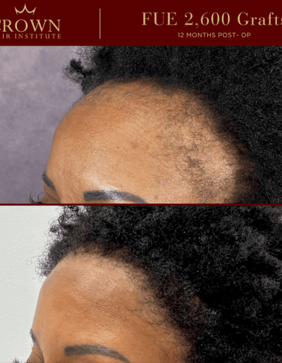 FUE Hair Transplant - Before and After Results