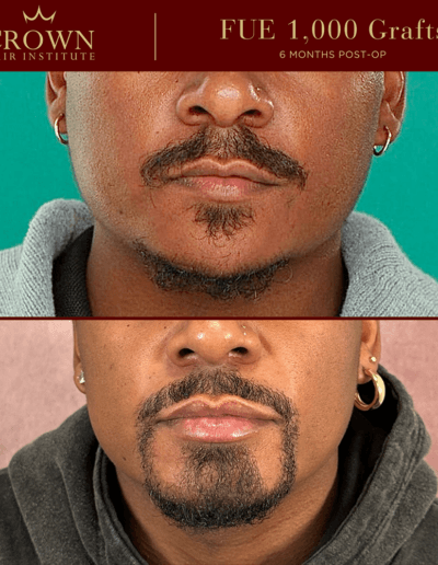 FUE Beard Transplant - Before and After Results