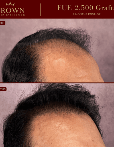 FUE Hair Transplant - Before and After Results