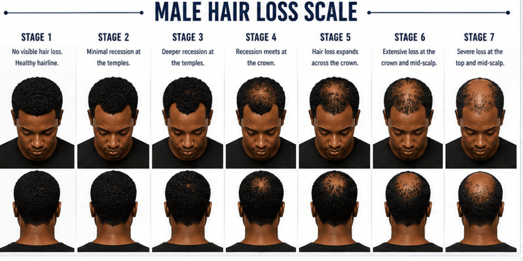 Male Hair Loss Scale showing 7 stages of progression